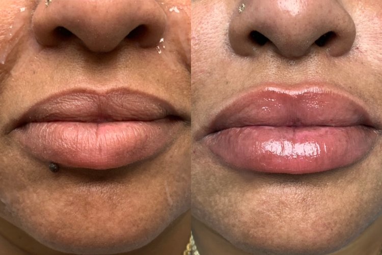 Before and after images of patient with lip filler