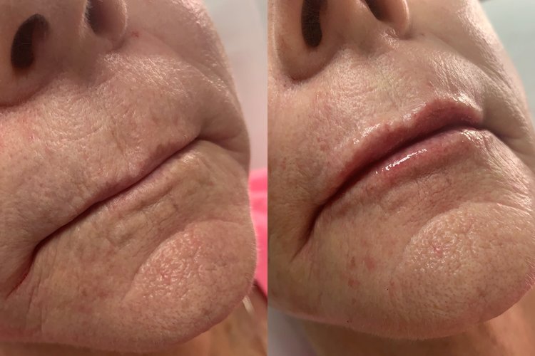 Before and after images of patient with lip filler