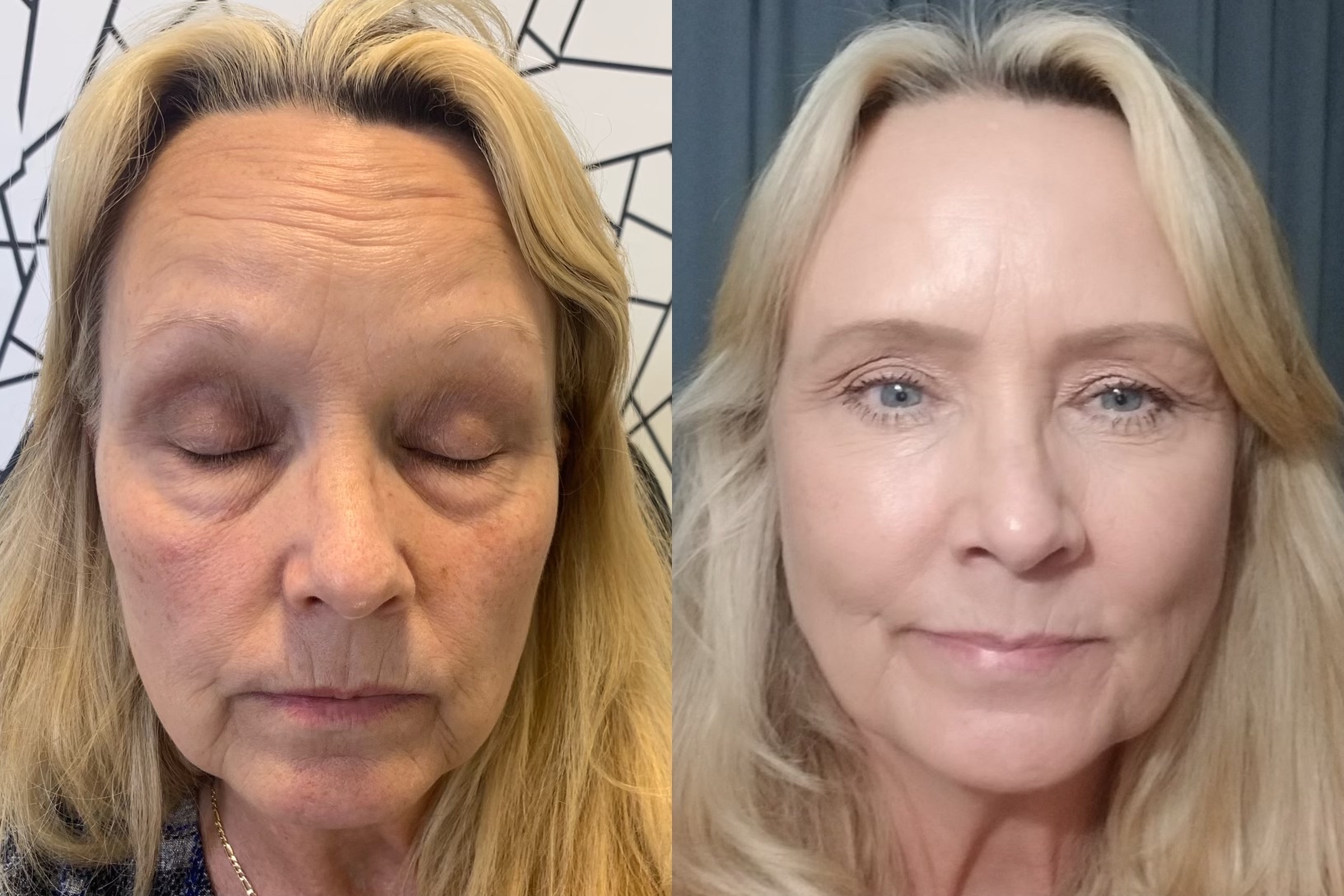 Patient doing botox image