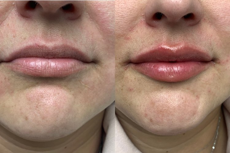 Before and after images of patient with lip filler