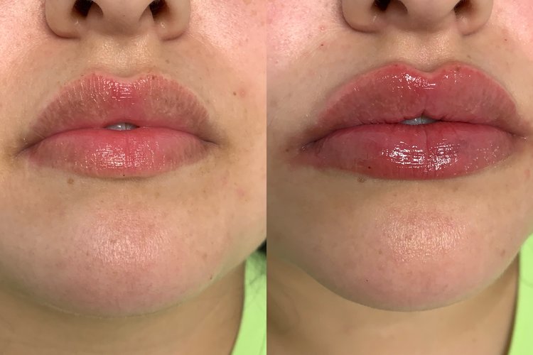 Before and after images of patient with lip filler